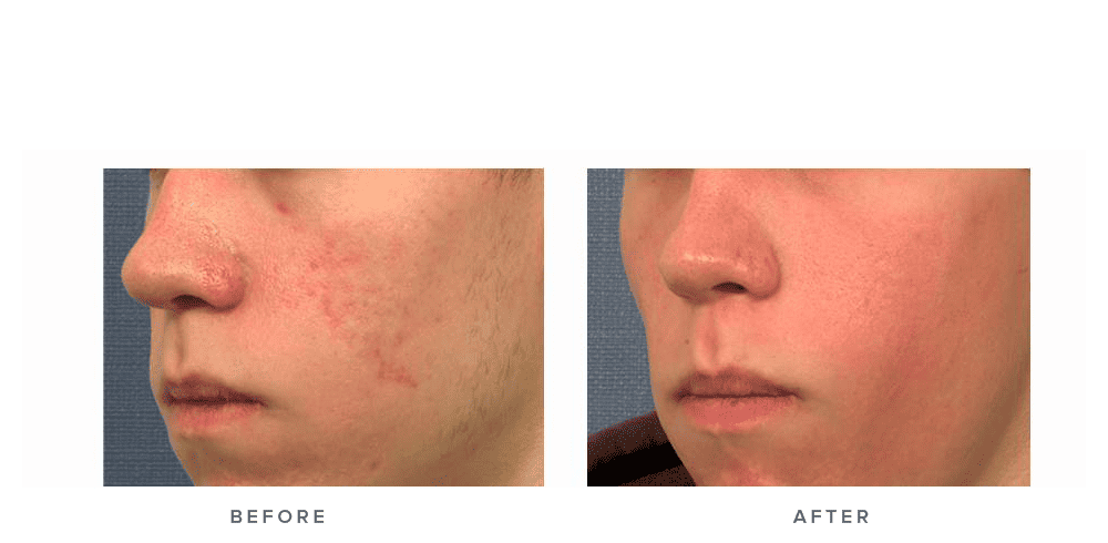 Fraxel Laser Before After My Journey To Flawless Skin - it9znb5