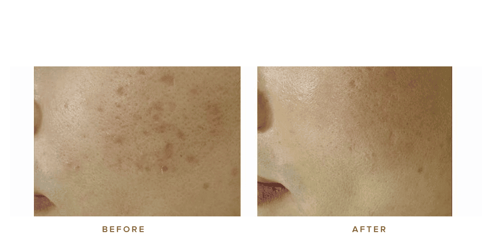 Fraxel Laser Before After My Journey To Flawless Skin - qy1asny