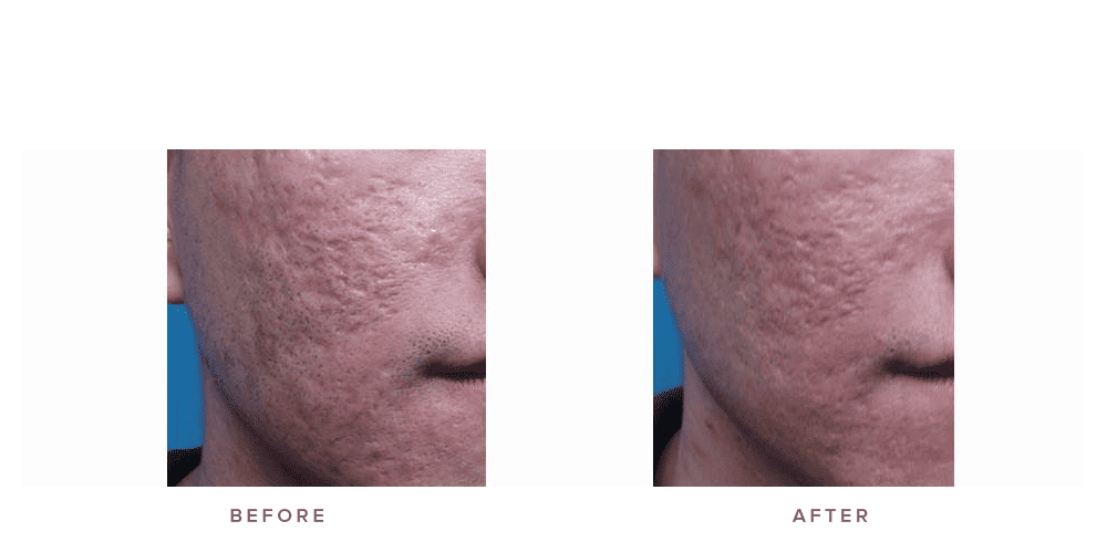 Fraxel Laser Before After My Journey To Flawless Skin - qbk83pp
