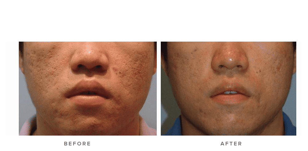 Fraxel Laser Before And After My Skin Transformation Is Unreal - 7wakmgh