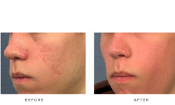 fraxel laser for acne scars - before and after - patient 001 - 45 degree view