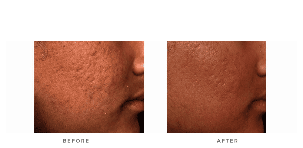 fraxel laser for acne scars - before and after - patient 002 - side view