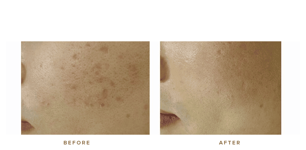 fraxel laser acne scarring - before and after - patient 003 - side view
