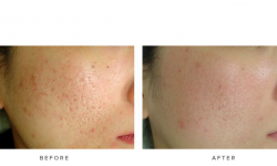 fraxel laser for acne treatment - before and after - patient 006 - side view