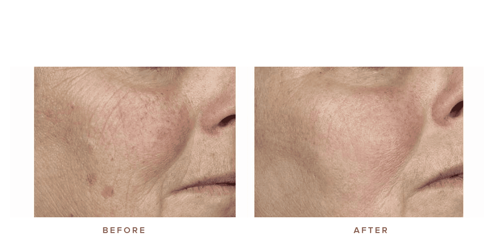 fraxel laser before and after - pigmentation texture and wrinkles 001