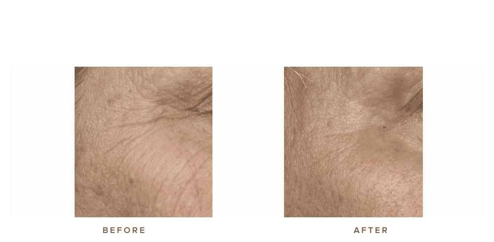 fraxel laser for pigmentation and texture wrinkles - before and after image 002