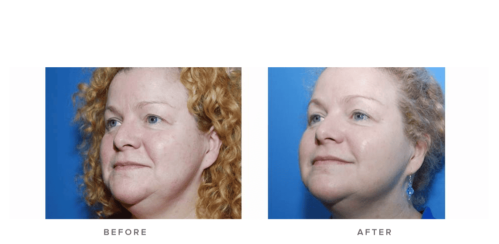 fraxel laser before and after 004 - pigmentation texture wrinkles - face
