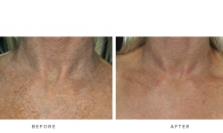 fraxel laser for sun damage and wrinkles - before and after - front