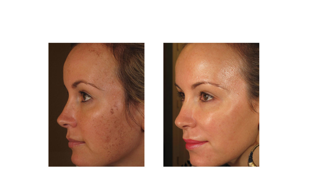 halo laser, forever young bbl, skintyte - before and after 010 - face - side view