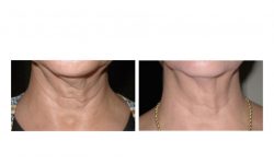 halo laser, forever young bbl, skintyte - before and after 013 - neck