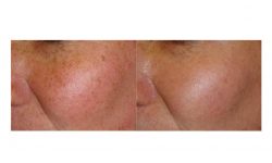 halo laser, forever young bbl, skintyte - before and after 016 - face