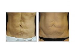 halo laser, forever young bbl, skintyte - before and after 004 - belly area