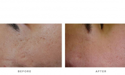 laser genesis treatment for scars - before and after - real patient
