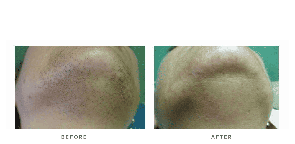 Laser hair removal before and after 01