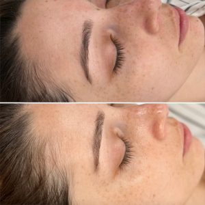 hydrafacial before and after - image gallery - female patient