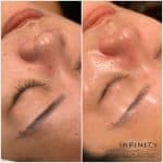 hydrafacial before & after gallery - infinity clinic sydney