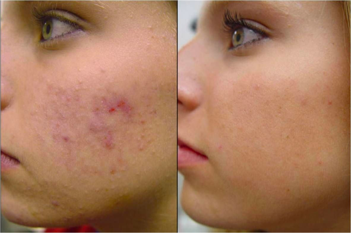 Vivace RF microneedling gallery 003 - before and after - side view