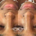 hydrafacial treatment before and after - image 001 - large