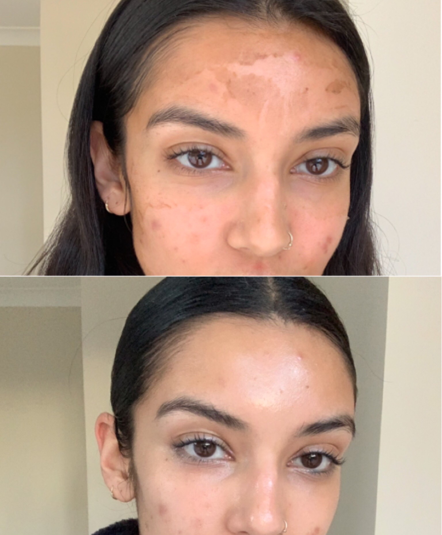 Medical Grade Skin Peels Medipeels Infinity Skin Clinic