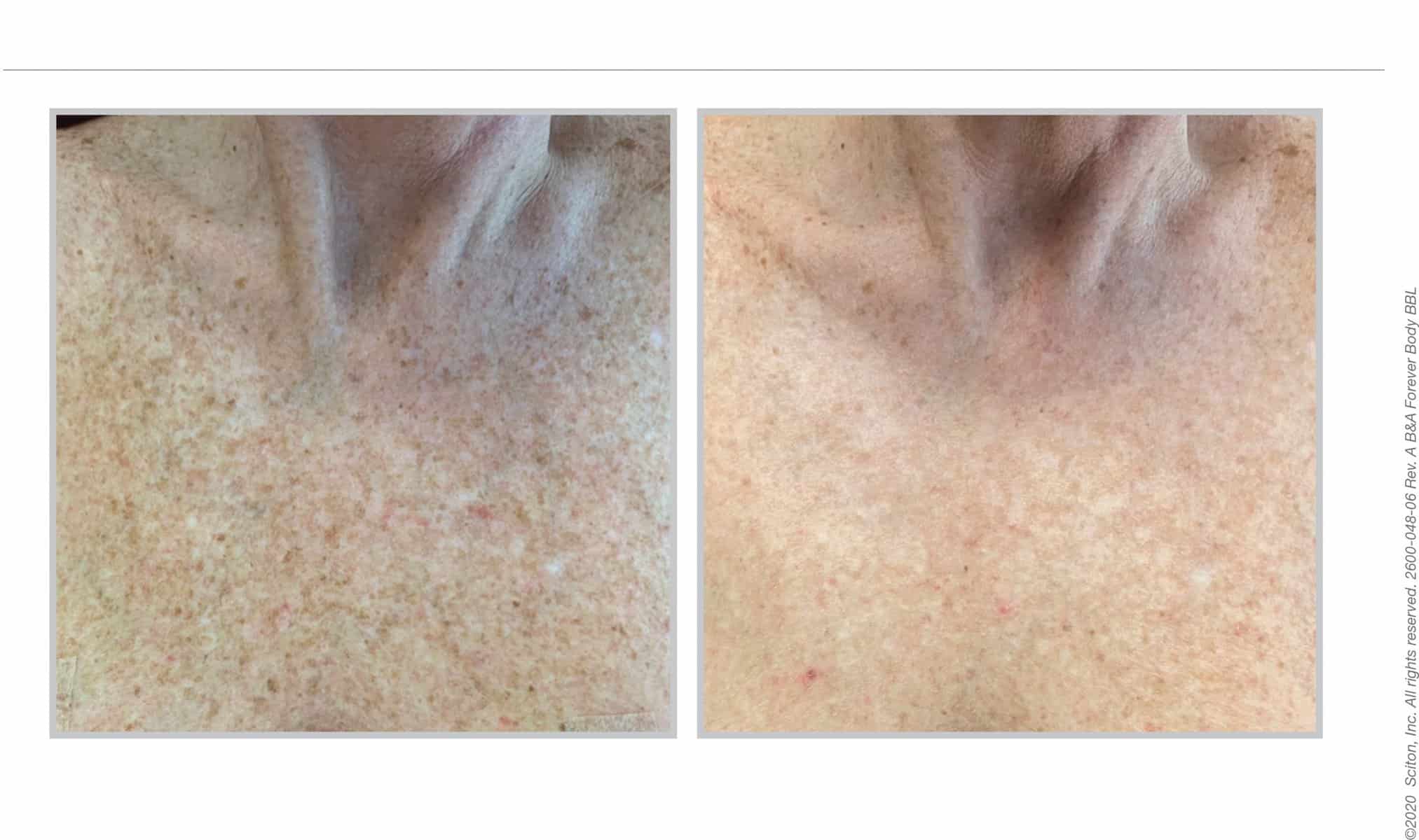 BBL decolletage treatment, before and after 13