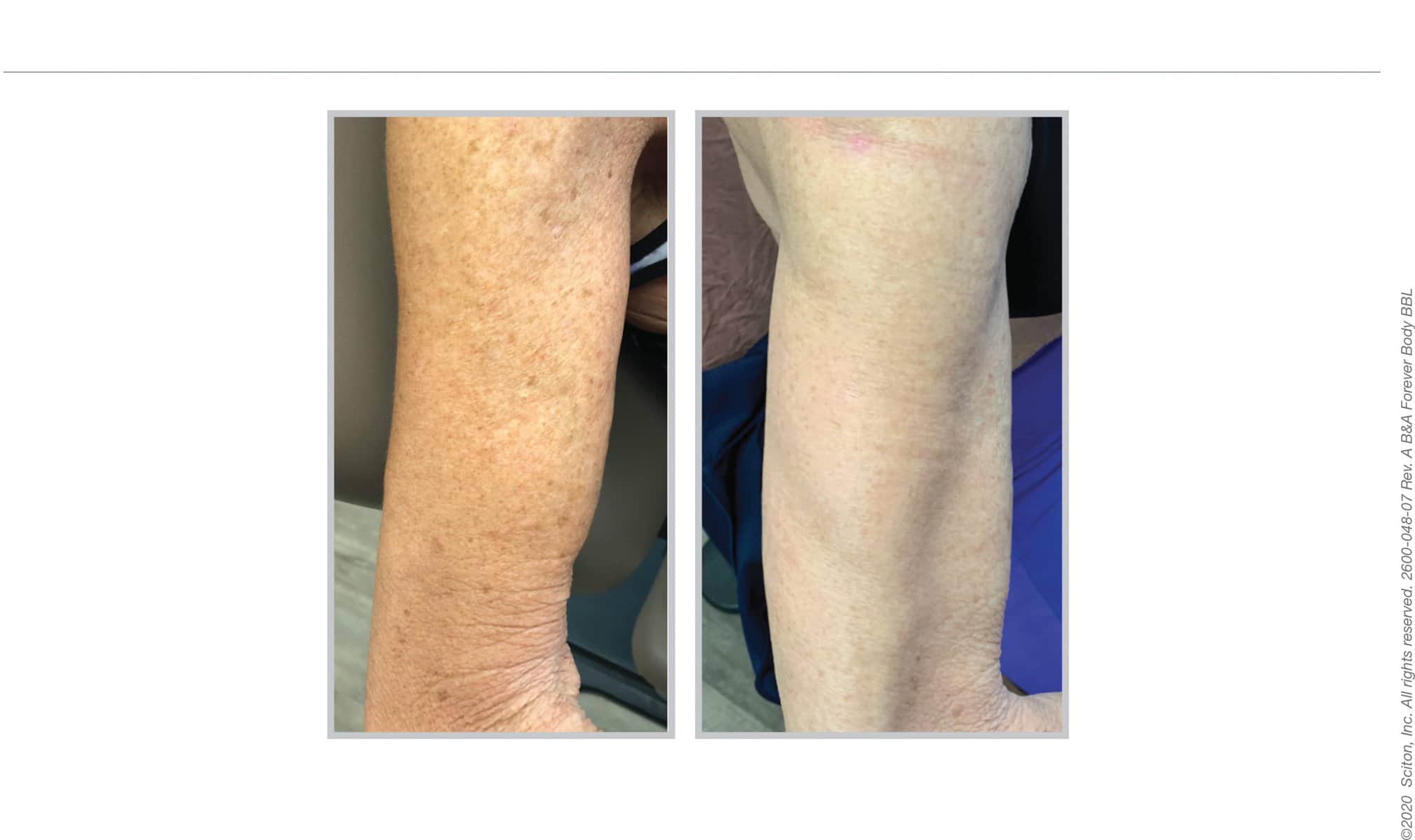 BBL Hero treatment on legs 12, before and after