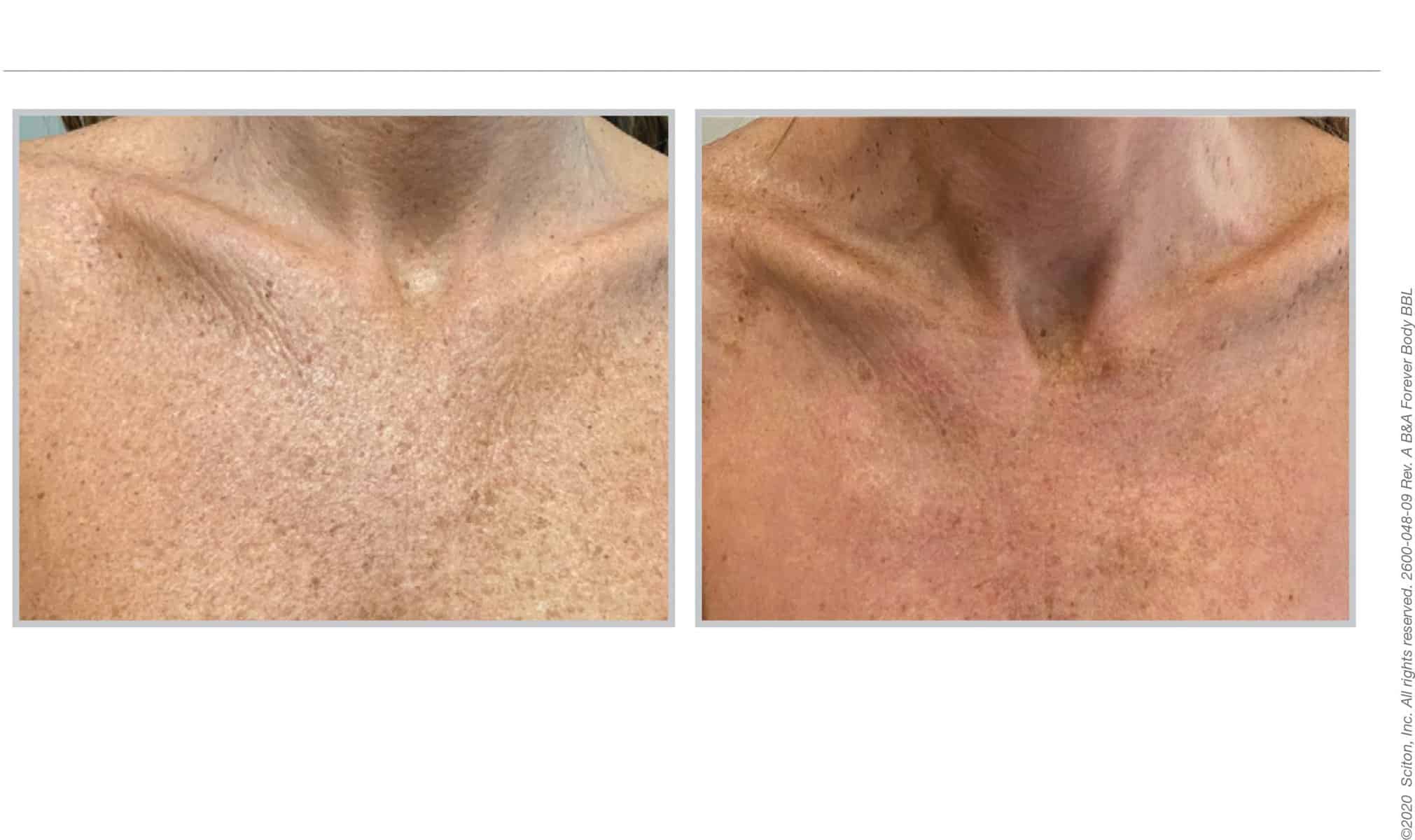 Before and afters 11, Forever Body BBL, décolletage area, Infinity Skin Clinic