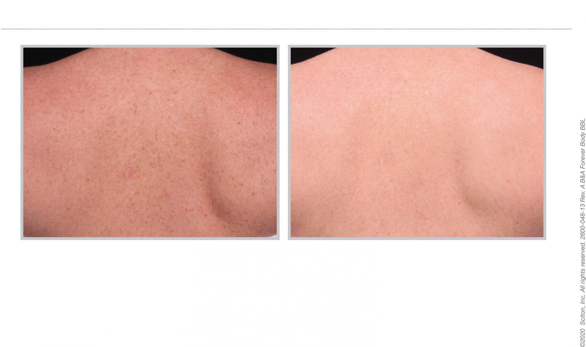 BBL Hero back treatment before and after 08