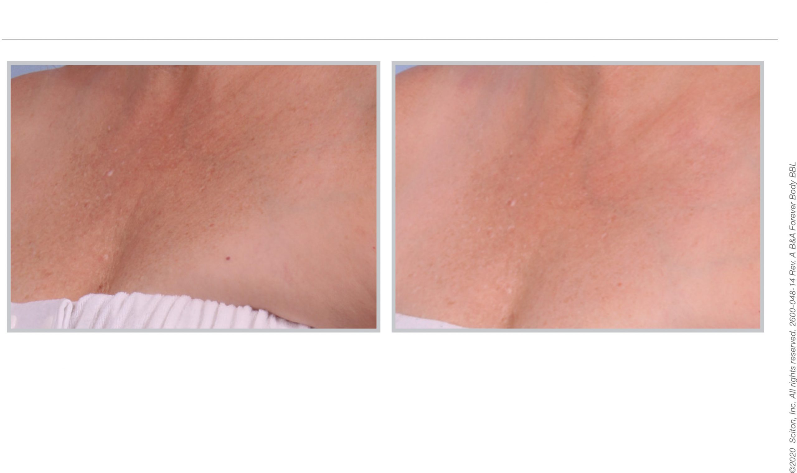 BBL treatment results 07, décolletage area, Infinity Skin Clinic Sydney