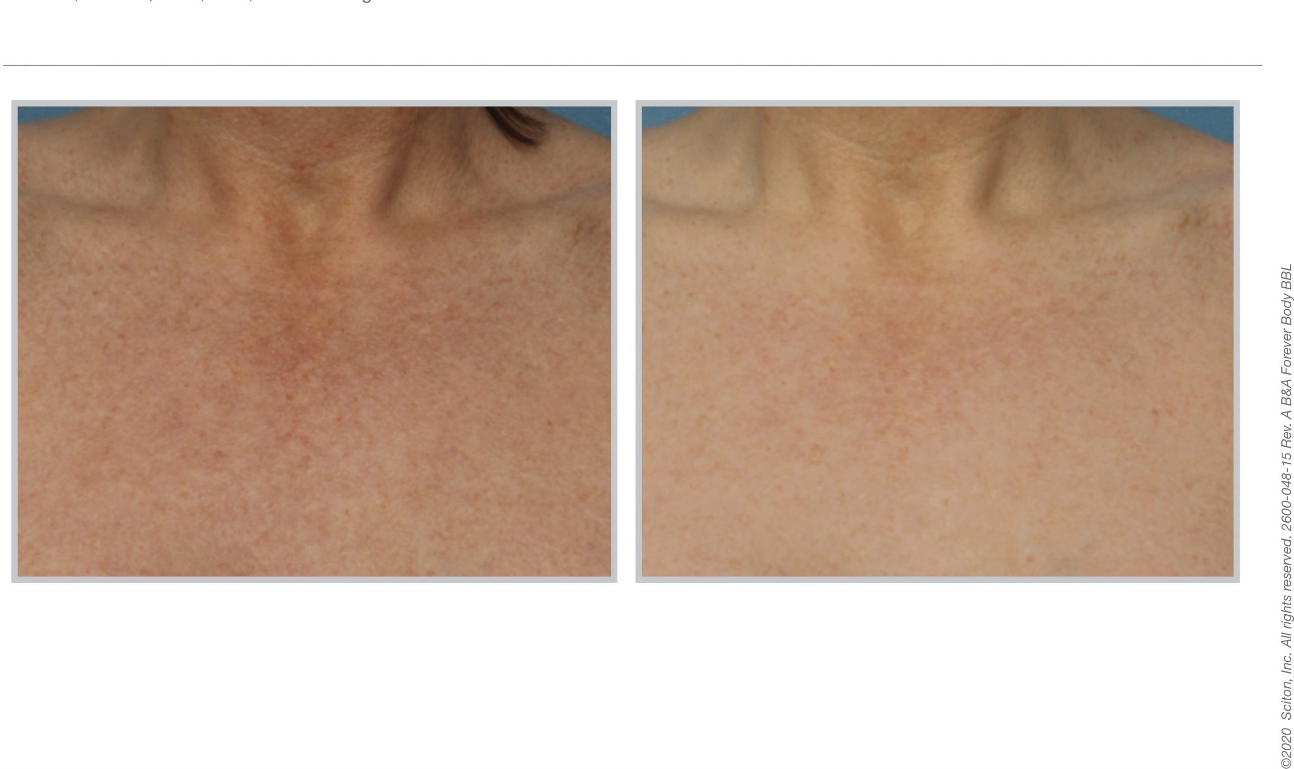 Patient before and after BBL Hero décolletage treatment 07