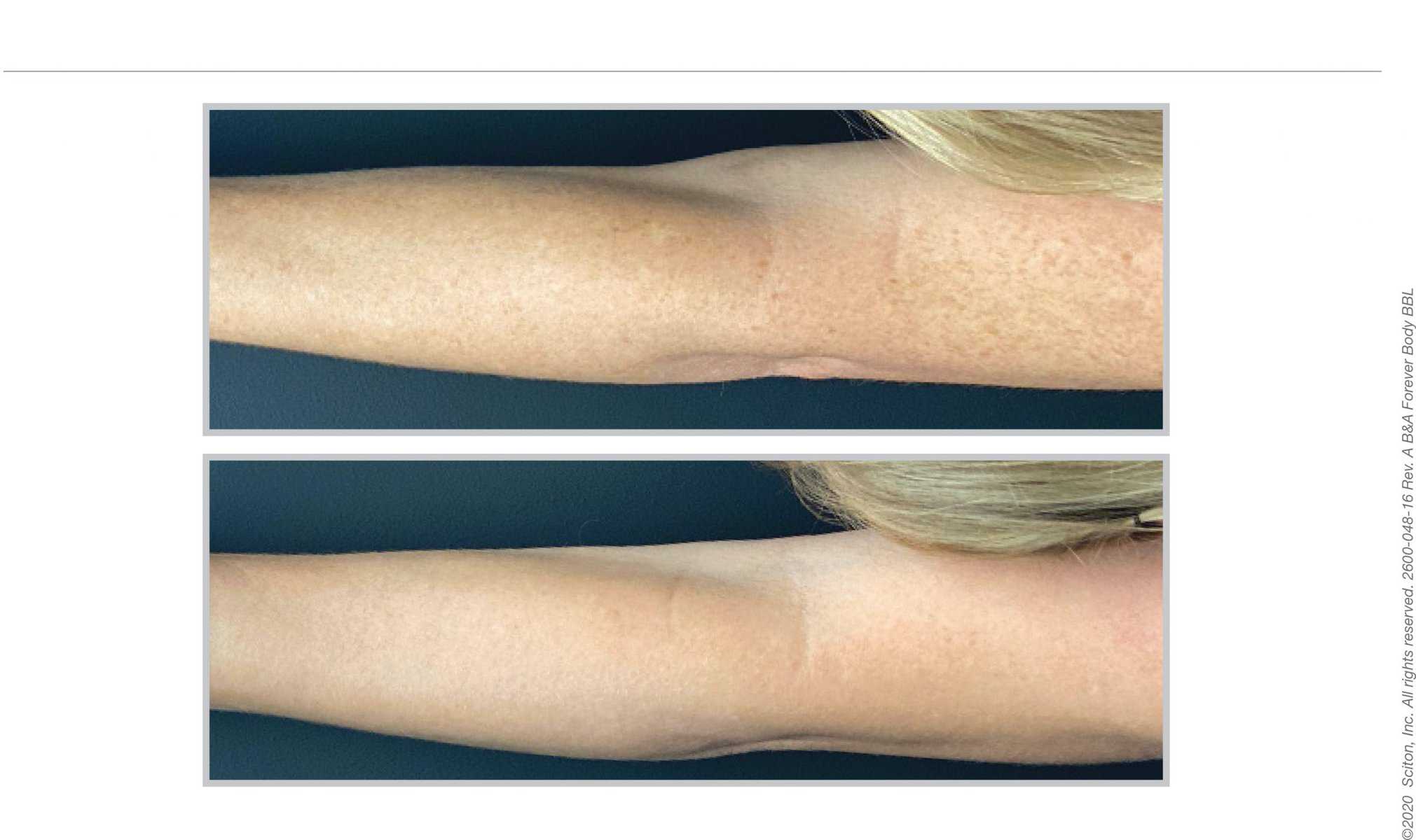 Female patient before and after BBL treatment 06, Infinity Skin Clinic Mosman & Surry Hills