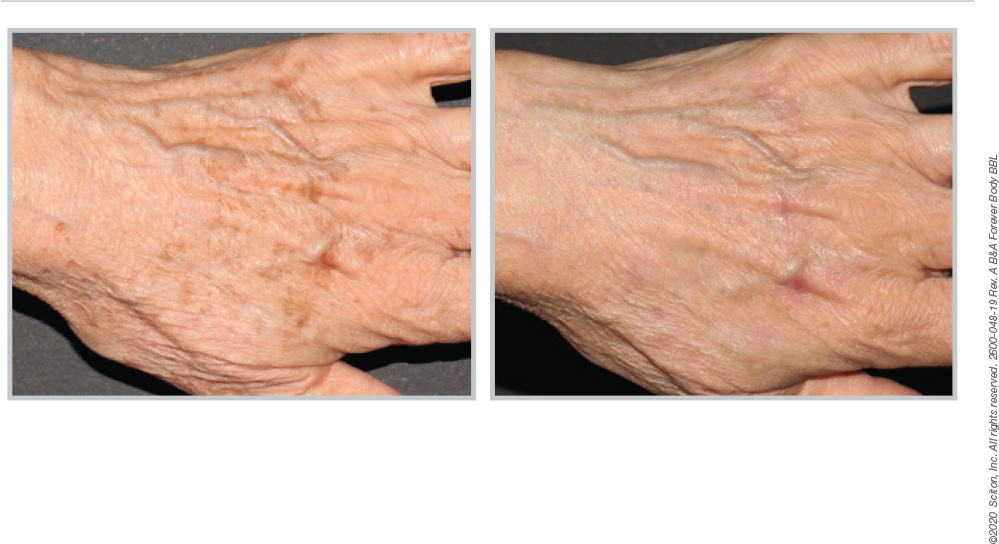 BBL Hero hand treatment results 03, before and afters