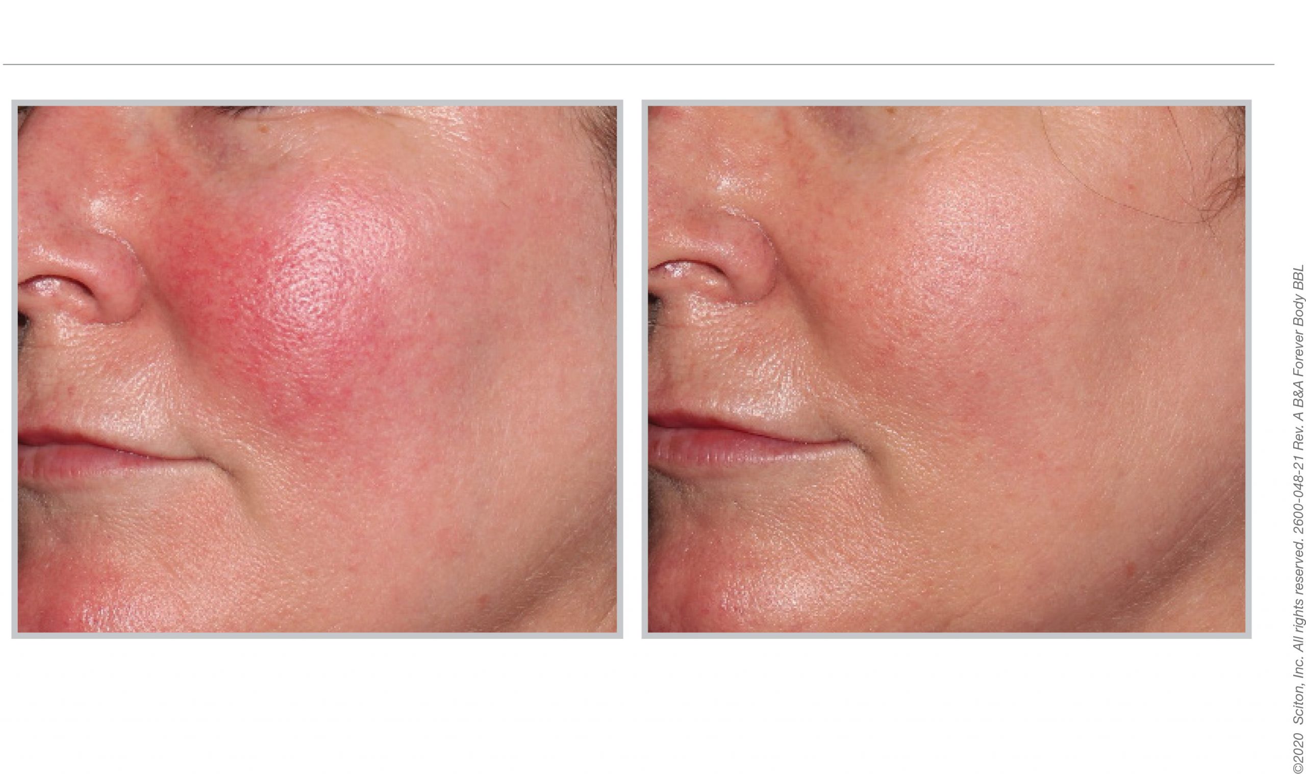 BBL Hero patient before and after treatment 01, Infinity Skin Clinic Sydney