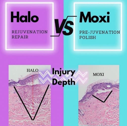 Halo vs Moxi 02