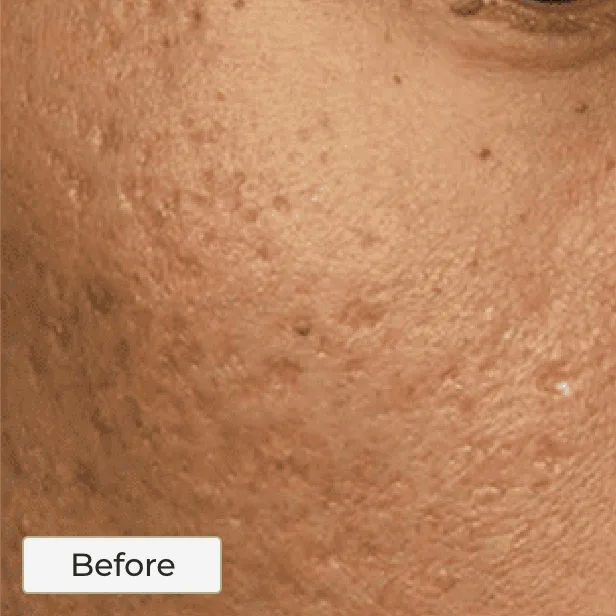 Acne Scarring