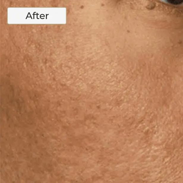 Acne Scarring