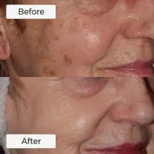 BBL Photorejuvenation model 03