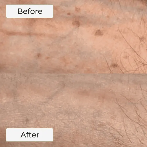 BBL Fotofacial 3 BBL Fotofacial - 2