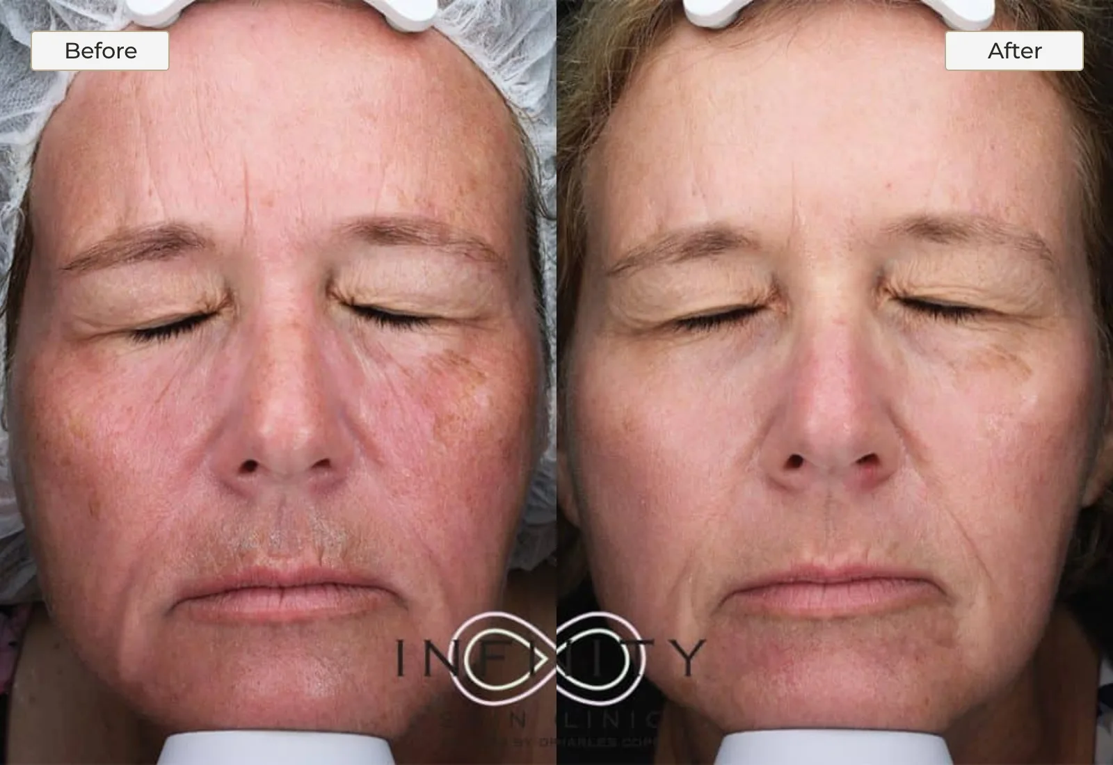 Facial Redness and Laser Resurfacing - 2