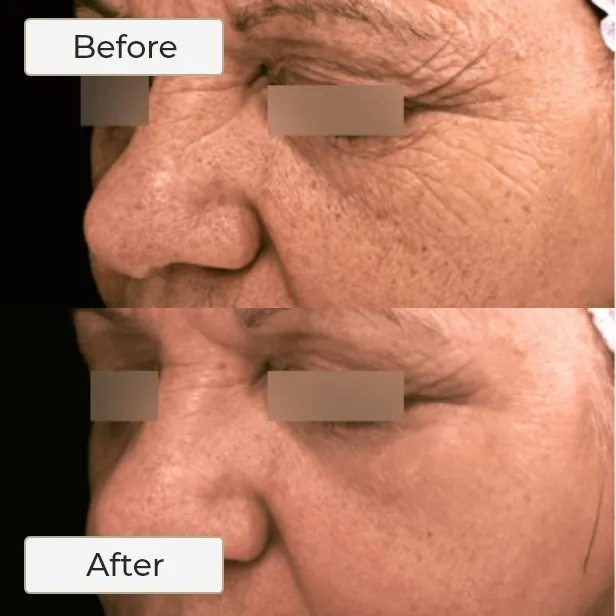 Dualmode Fractional Laser Resurfacing 2 DUALMODE FRACTIONAL LASER RESURFACING