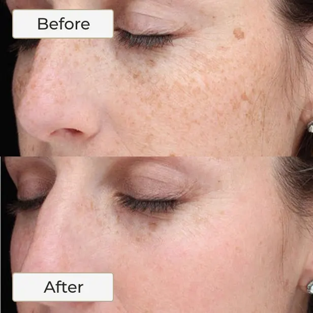 Halo Laser 1 HALO LASER SKIN TREATMENT