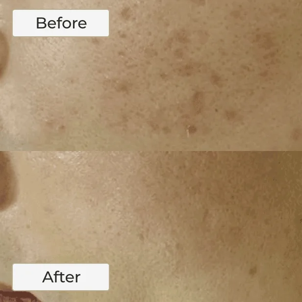 LASER SKIN RESURFACING