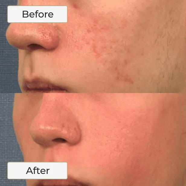 Facial Redness and Laser Resurfacing - 1