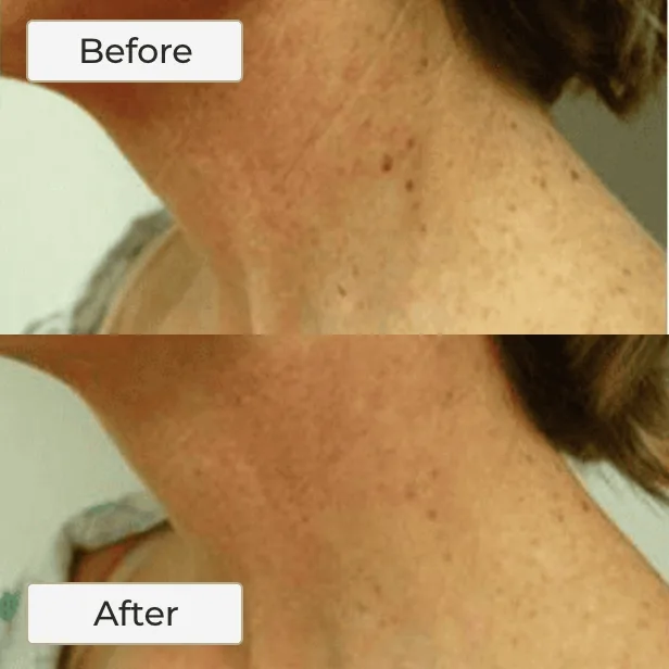NECK LASER TREATMENT