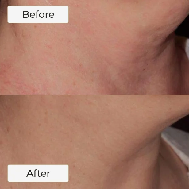 NECK LASER TREATMENT