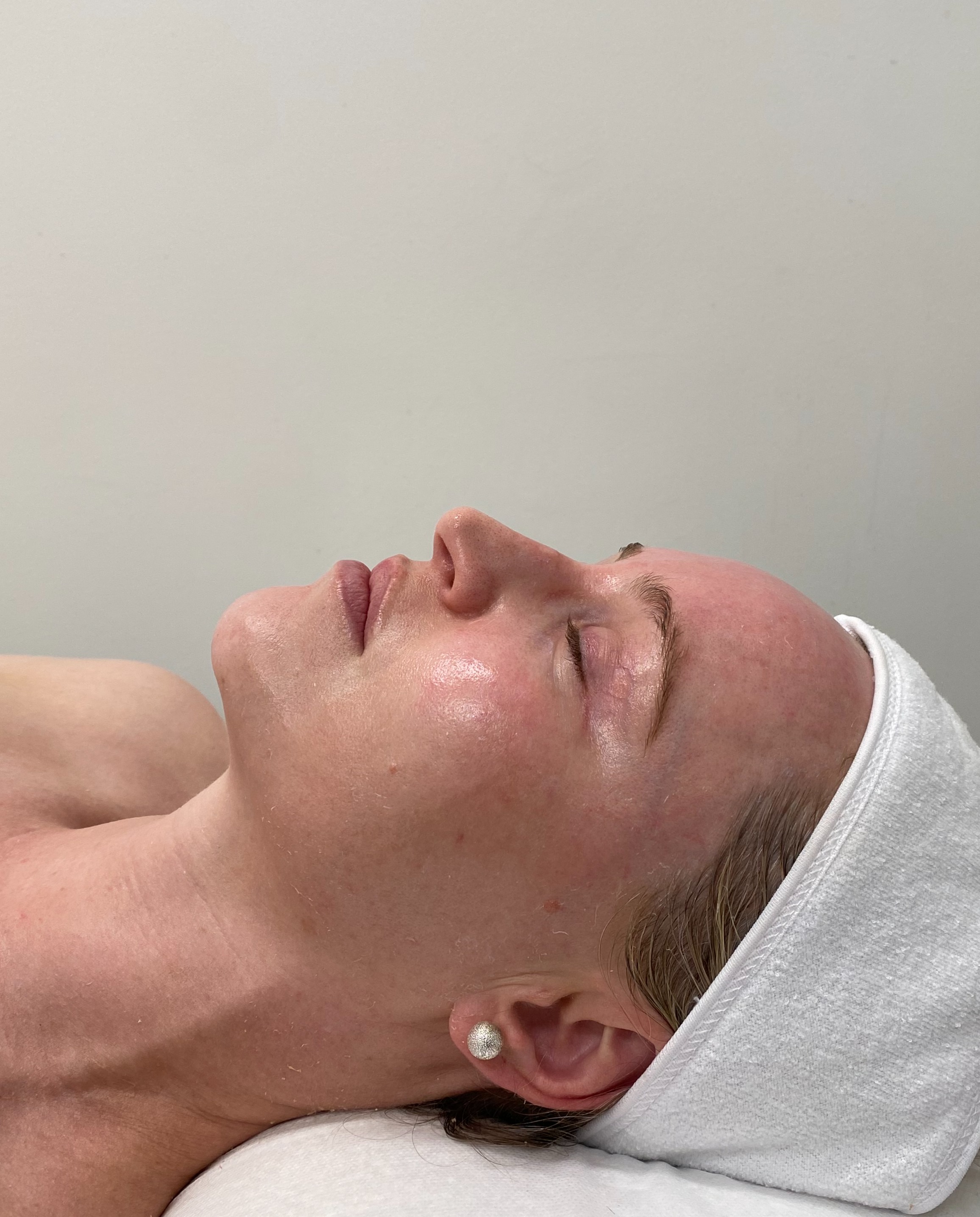 Dermaplaning Facial Treatment 1 Dermaplaning Facial Treatment - 1