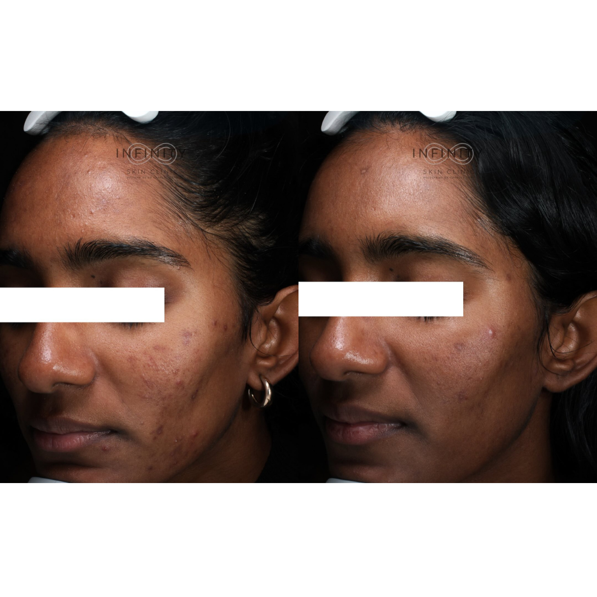 Skinpen Microneedling - 1